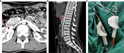 Case Report: An Unusual Case of Nutcracker Syndrome and Literature Review